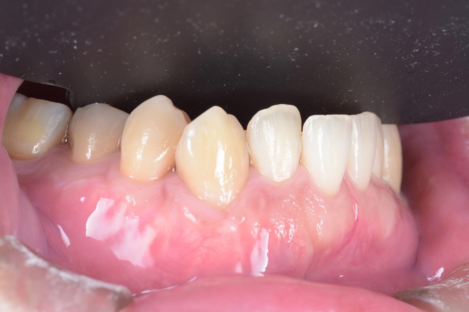 術後36ヶ月：CTG＋SNAIPによる根面被覆後の臨床写真